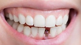 Smile with dental implant