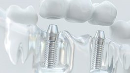 Illustration of two dental implants supporting a dental bridge