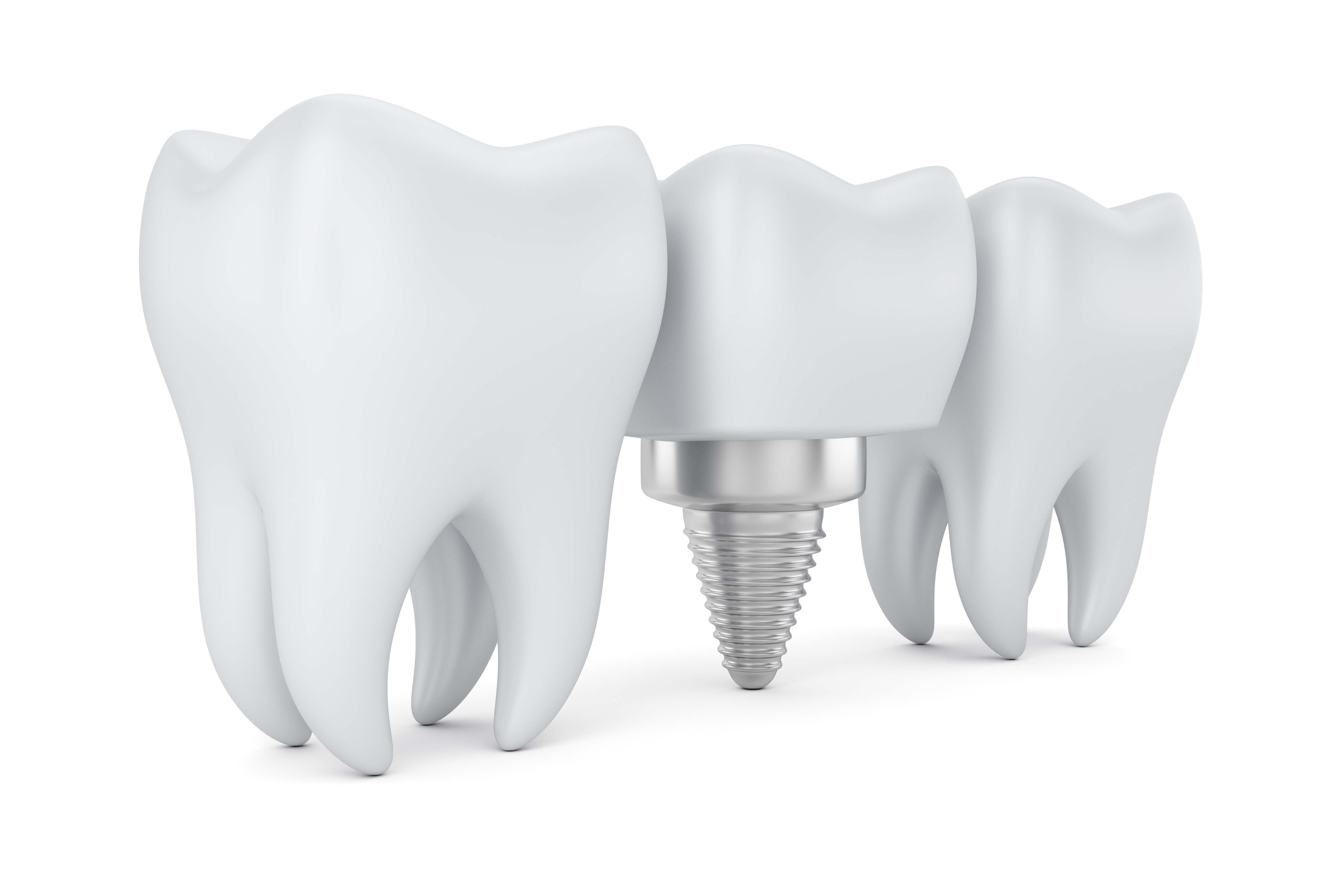 Импланты зубов без фона